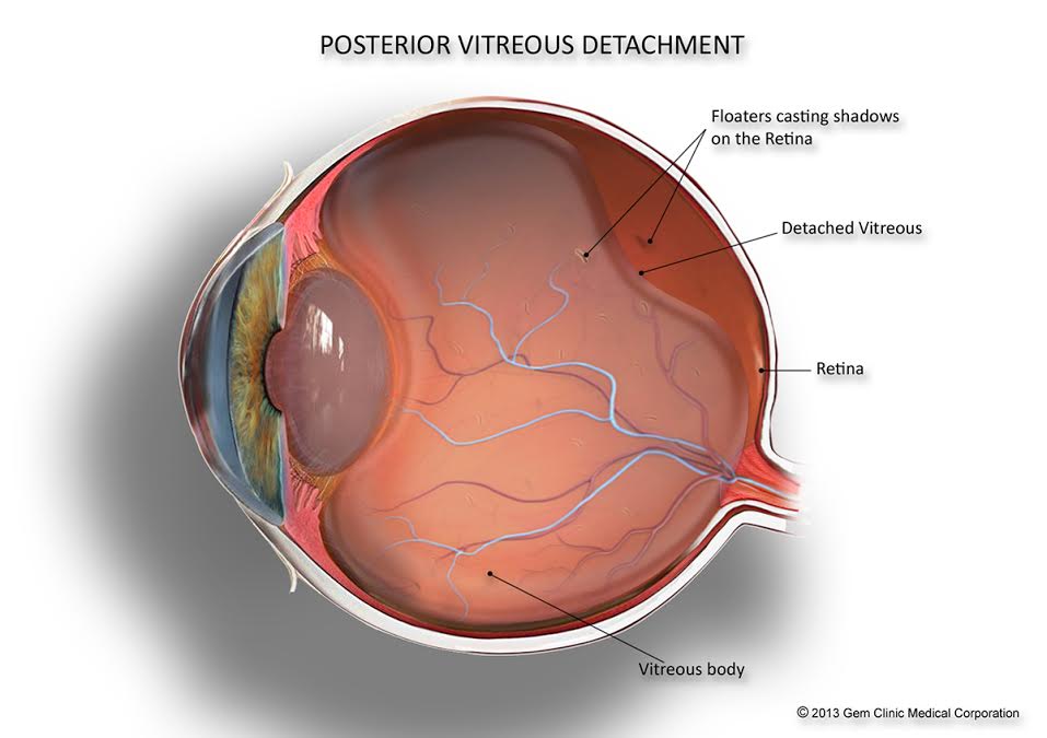 retinal detachment vision